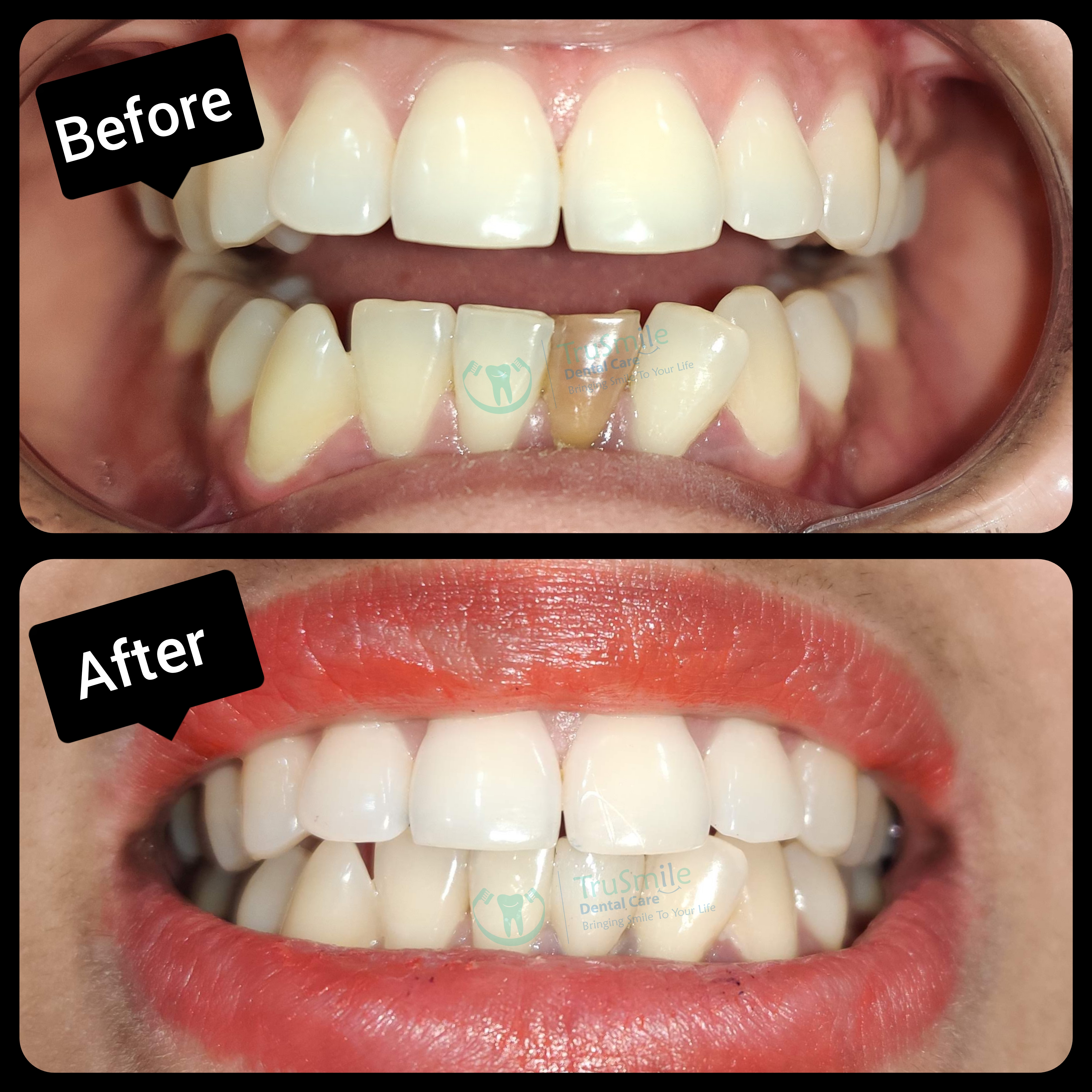 Smile Design 13